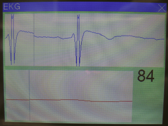 ECG Display